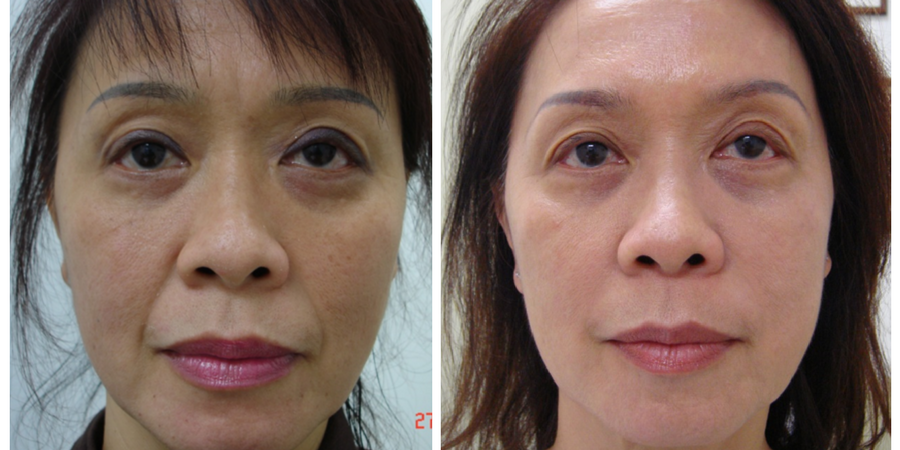Special offers- Clearlift treatment before and after