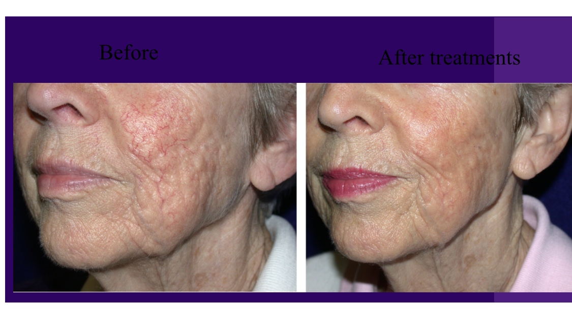 clearlift treatment-before and after