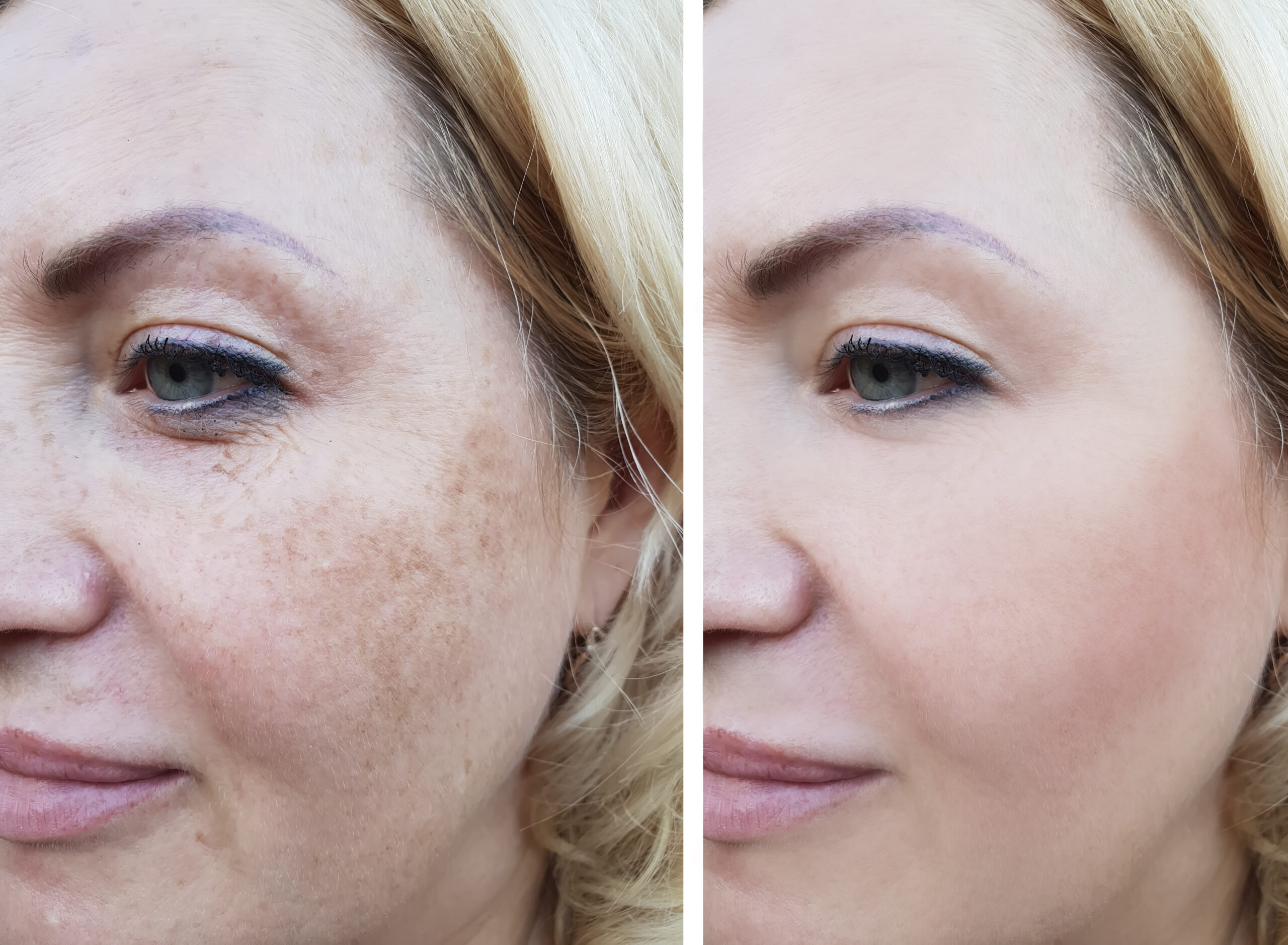 female face wrinkles before and after, pigmentation