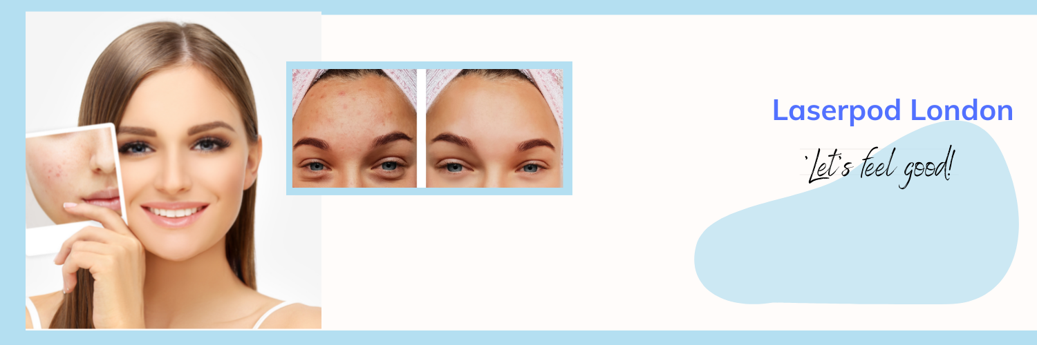 Pre and post treatment pictures- Acne treatment
